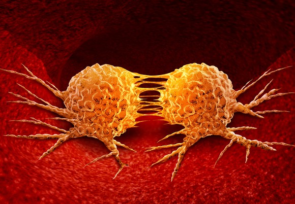 Two cancer cells dividing.