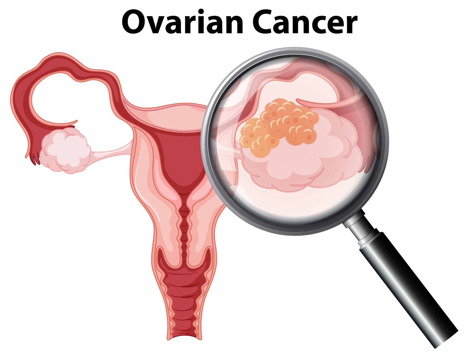 Magnifying glass looking at cartoon illustration of ovarian cancer