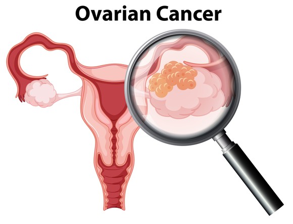Magnifying glass looking at cartoon illustration of ovarian cancer