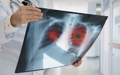 Lung cancer x-ray