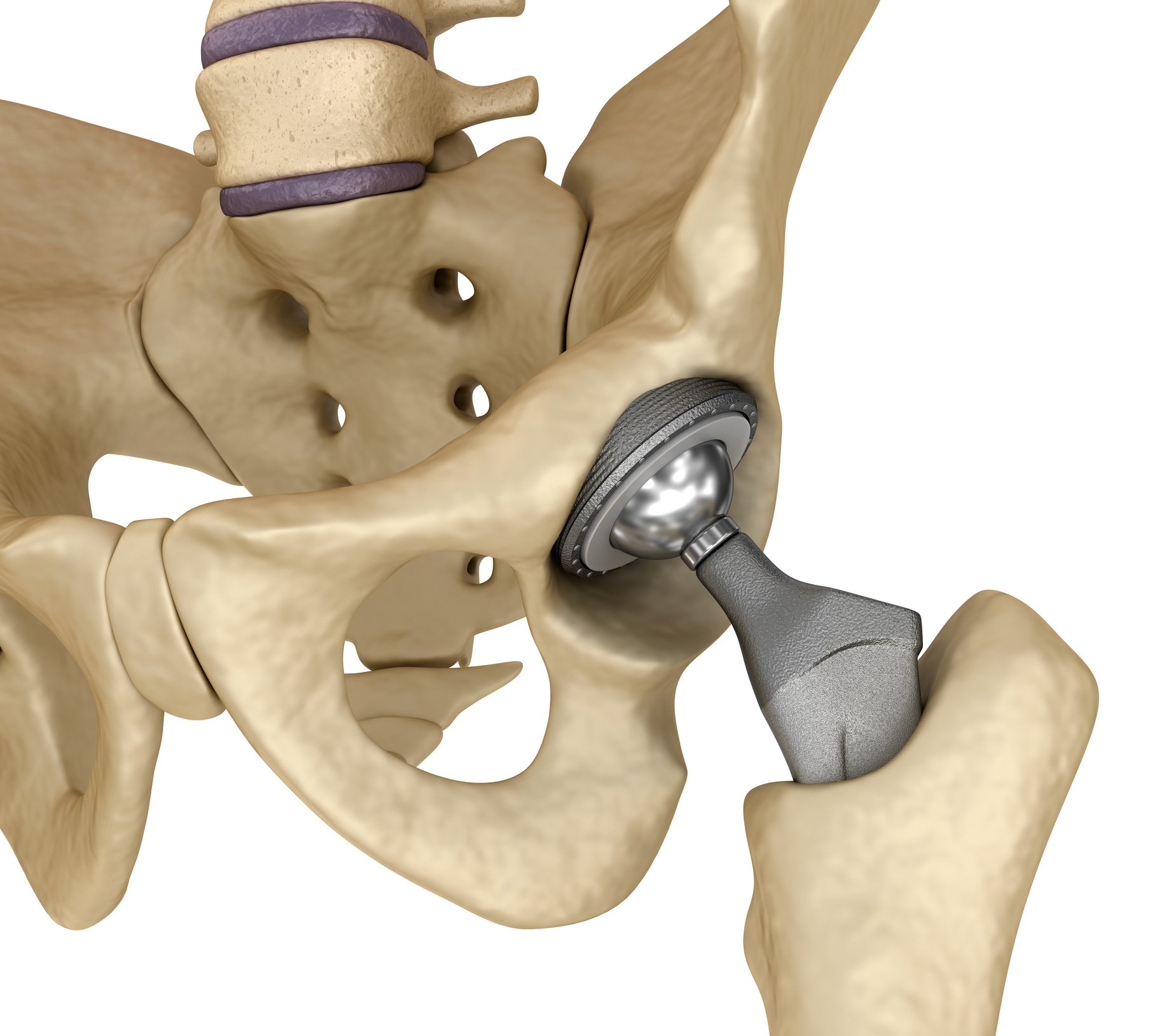 Hip replacement implant