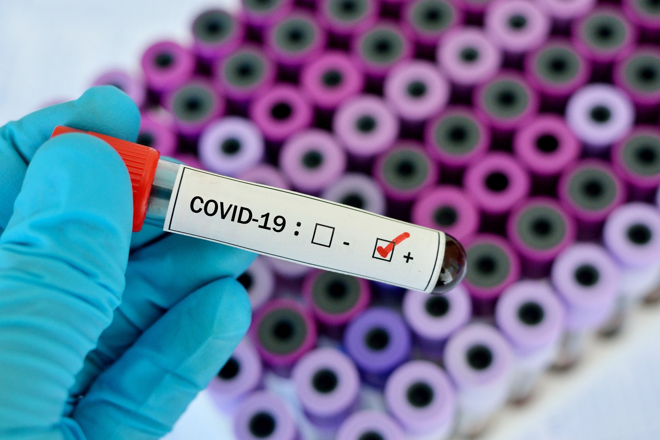 Hand holding vial with a label showing COVID-19 positive