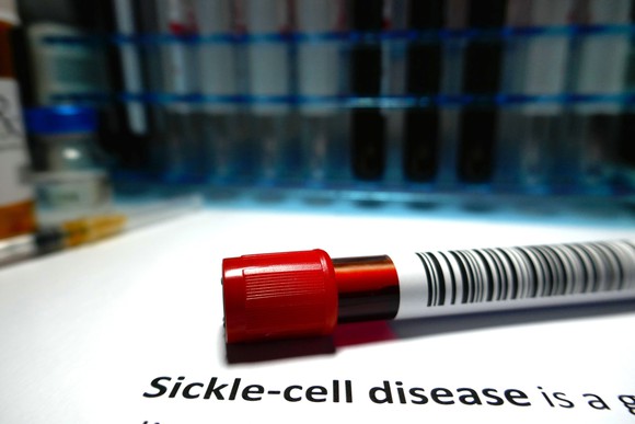 Vial with blood sample on top of a document with "Sickle-cell disease" printed on it