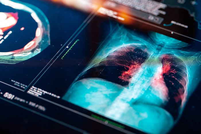 Computer image of a lung x-ray.