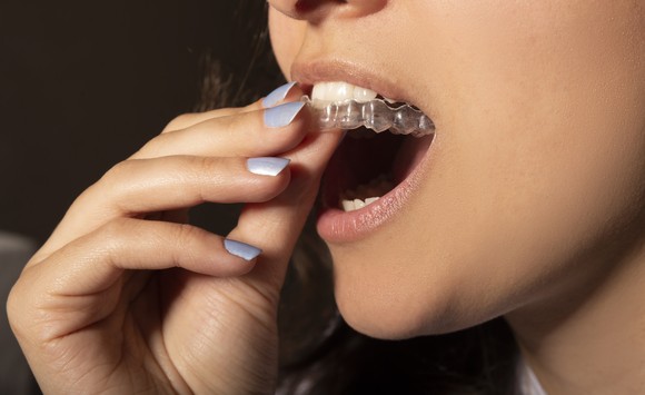 A person putting a clear aligner on teeth.