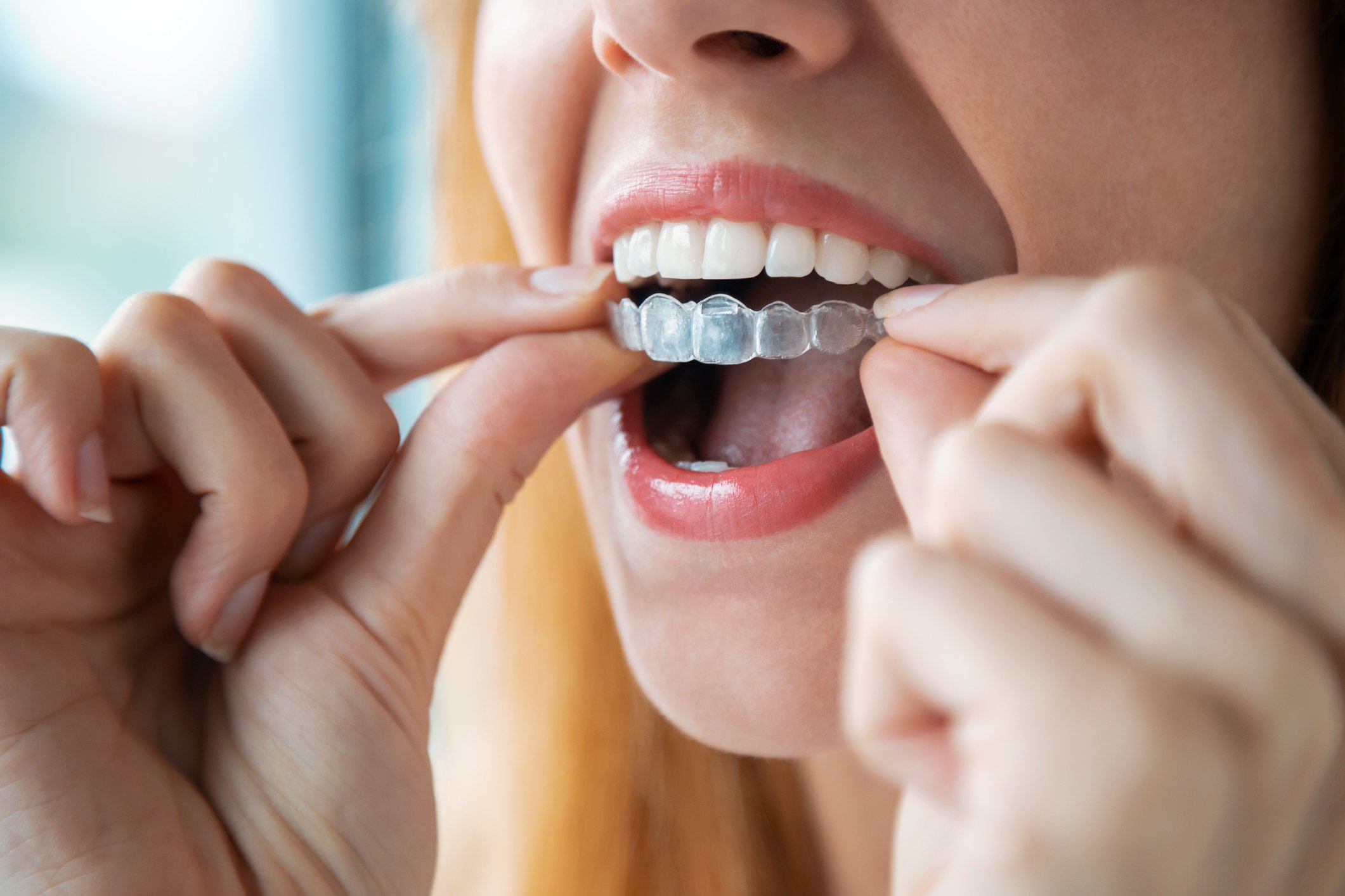Align Technology - GettyImages-1226447065