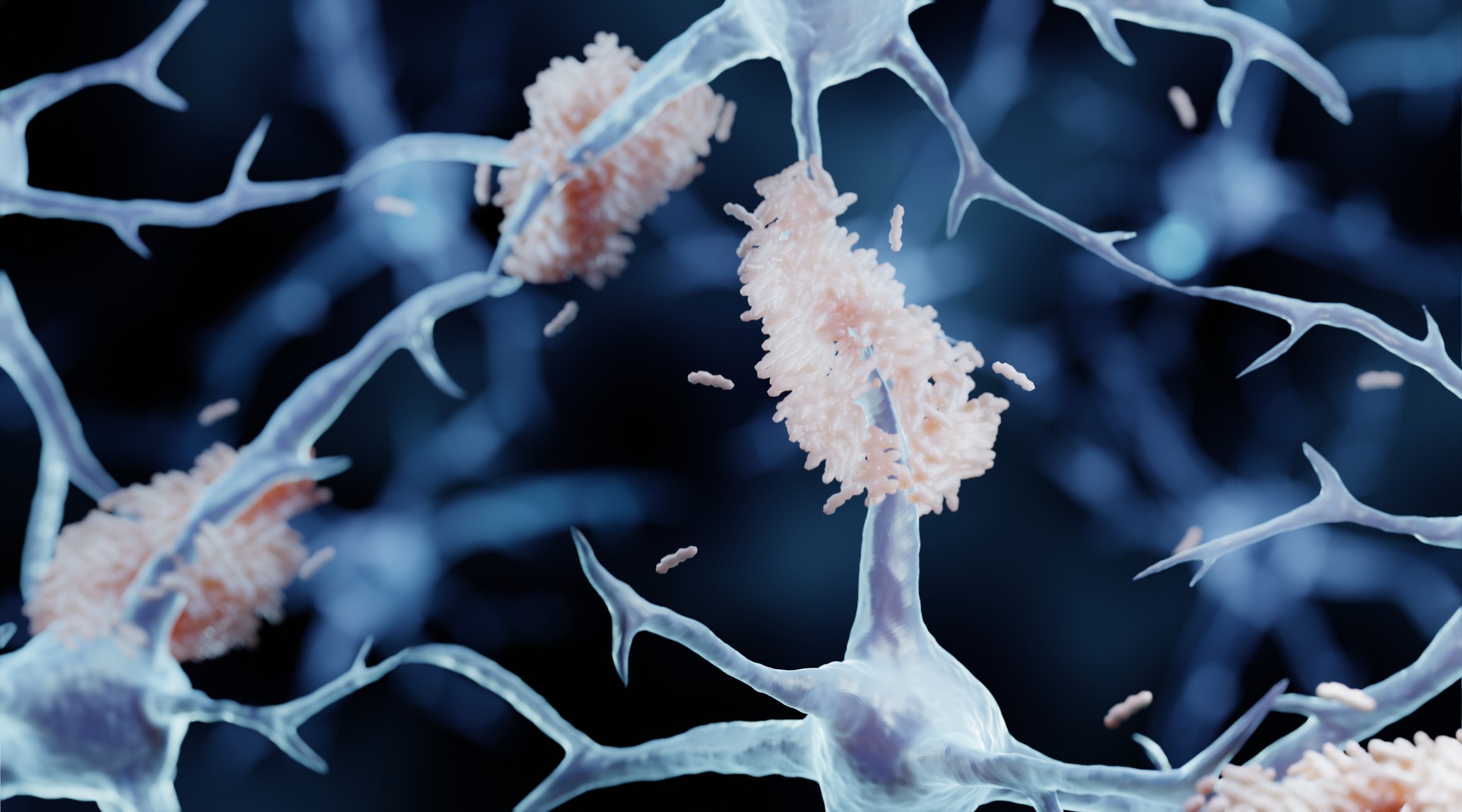 amyloid plaques