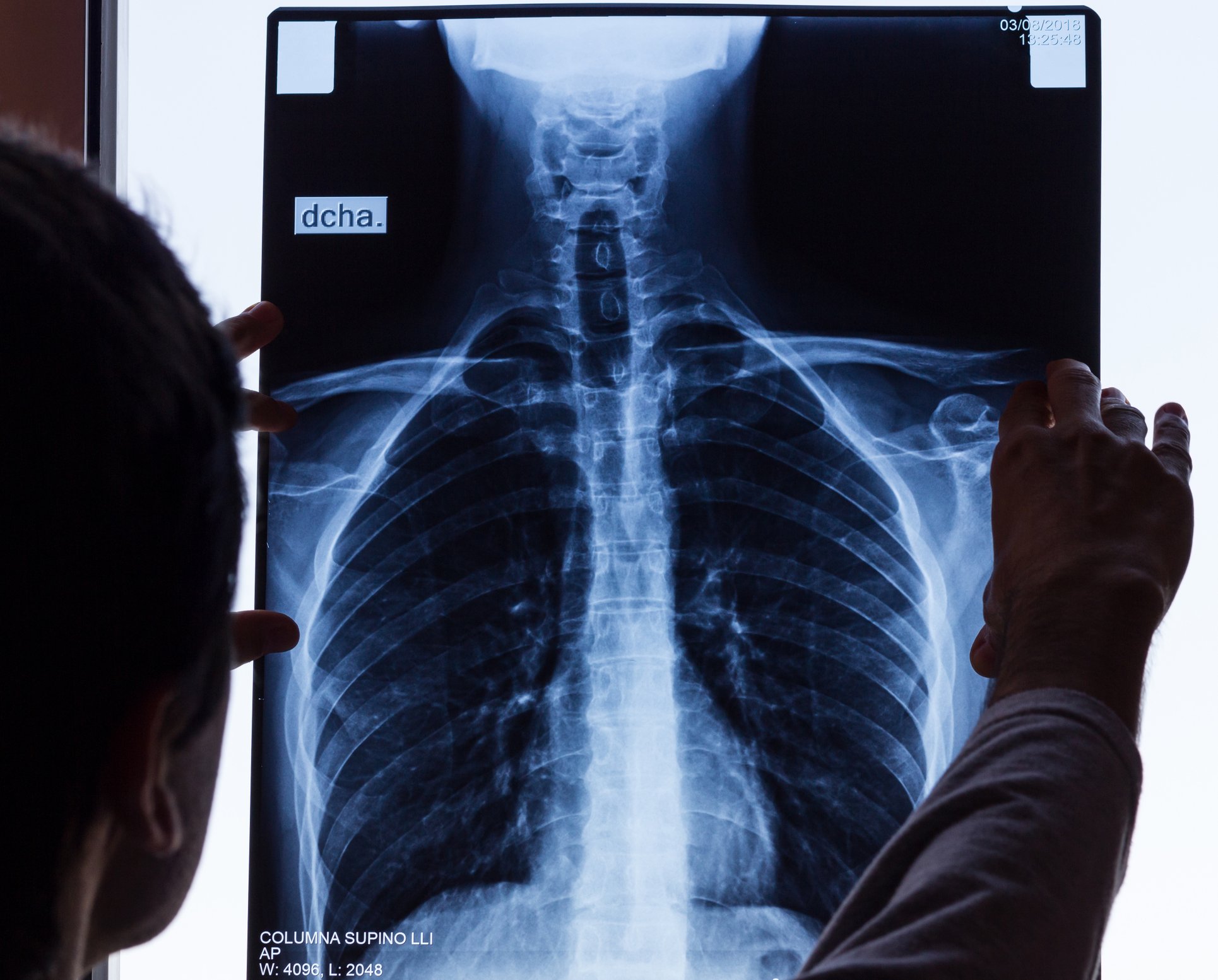 Doctor checking on chest X-ray