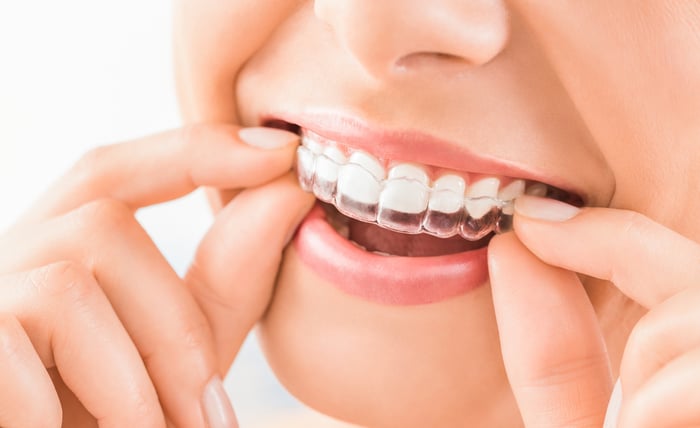 A woman applying see-through aligners to her teeth braces orthodontist