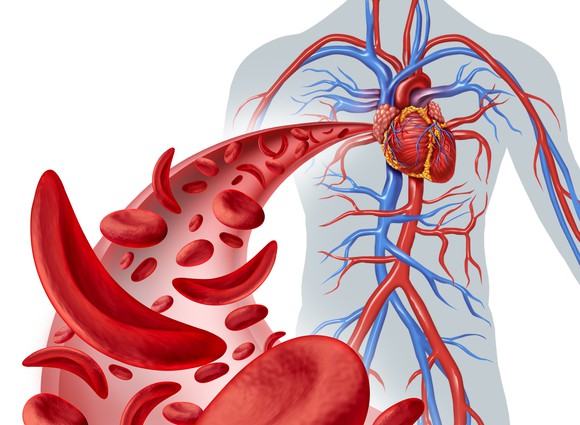 Illustration of circulatory system with sickle cells inside an artery.
