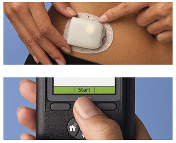 A two-pane image with the top pane showing an Omnipod attached to a woman's lower stomach and the bottom pane showing the handheld control for the device.