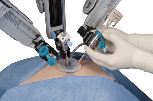 Two gloved hands manipulated a robotic surgical system above a patient's exposed abdomen.