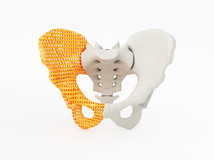 3D-printed hip bone.