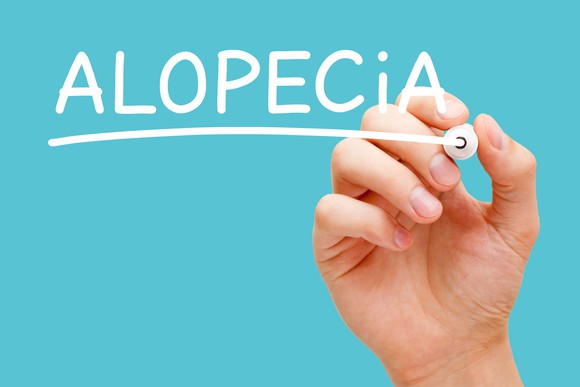 A hand writes the word "Alopecia" in white on a blue background.